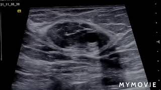 breast hamartoma • ultrasound case [upl. by Ahsielat617]