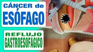 Cáncer de Esófago y Reflujo Gastroesofágico [upl. by Nniroc931]