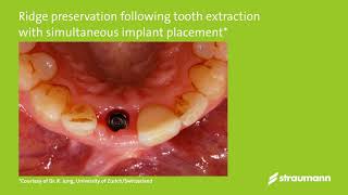 Clinical use of Straumann® BoneCeramic Dr Jung [upl. by Sheff]