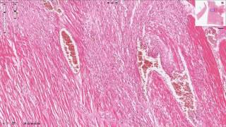 Myocardial Infarction  Histopathology [upl. by Elleimac301]