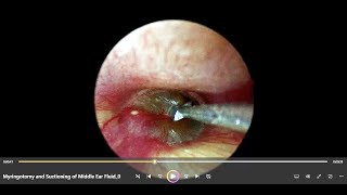 Myringotomy and Suctioning of Middle Ear Fluid In Acute Otitis Media [upl. by Rodolph977]