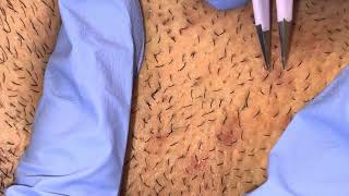 Ingrown Hairs Plucked from Beard [upl. by Emee]