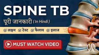 Spinal TB Symptoms Diagnosis And Treatment  Best Doctor For Spine TB In India  Dr Nandan Marathe [upl. by Ardnuaet388]