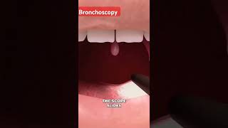 Bronchoscopy mbbsdoctor medicalcollegestudents studentdoctor medicaldegree hospital [upl. by Ileek]