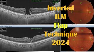 Macular Hole Inverted ILM Flap Technique 2024 [upl. by Ogeid]