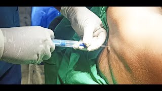 Epidural Anaesthesia  2  techniques  DrSParthasarathy MDDNB PhD [upl. by Asena205]