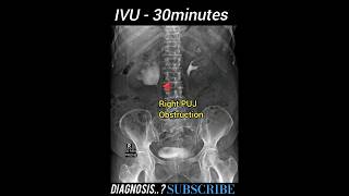 PUJ Obstruction  IVU  Diagnosis  Practical Case Radiology [upl. by Airakaz]