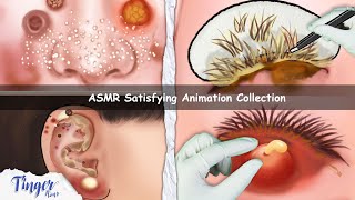 ASMR CARE ANIMATION COLLECTION  Cleaning Big Hole Swollen Ear Dry Eyelid Sebum Extrusion [upl. by Etak]