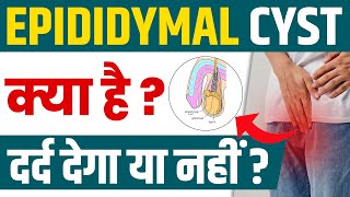 Epididymal cyst क्या है दर्द देगा या नहीं   Ayurvedic Treatment For Epididymal Cyst  Dr Health [upl. by Caputto]