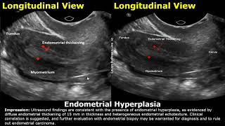 Uterus Ultrasound Reporting  Uterine Disease Scan Reports  How To Write USG Report  Pelvic USG [upl. by Llenrap]