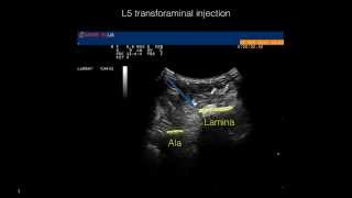 Ultrasound guided left L5 transforaminal injection [upl. by Leziar]