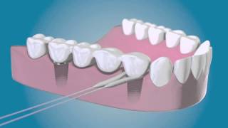 Rengör kring dina tandimplantat med TePe Bridge amp Implant Floss [upl. by Ossie]