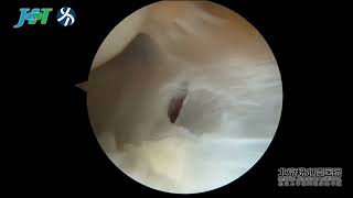 Arthroscopic Repair of Extensor Carpi Radialis Brevis in Patients With Tennis Elbow [upl. by Nilhtac]