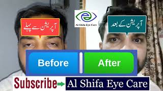 Ptosis Droopy Eyelids Treatment  Jhuki rehne wali palkon ka ilaj in Pakistan [upl. by Chapel]