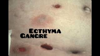 ecthyma causes symptoms and treatment dermatologyskin disease [upl. by Zasuwa619]