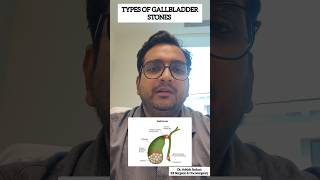 Types of gall bladder stones DrAshishSachan [upl. by Airret]