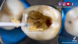 ¡🔥VIDEO HD eliminación de CARIES DENTAL con alta velocidad en una muela SIN DOLOR 😫🔥 [upl. by Sinylg552]