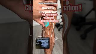 🔥✅💯How to check bursitis Prepatellar bursitis clinical examinationclinicalexaminationbursitisyt [upl. by Okier647]