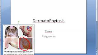 Microbiology 573 a DermatoPhytosis RingWorm Trichophyton Microsporum Epidermophyton ID reaction [upl. by Osi18]