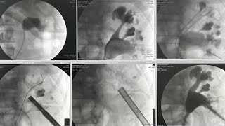 PCNL of staghorn renal stone [upl. by Adnorehs]