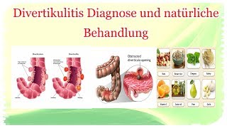 Divertikulitis Diagnose und natürliche Behandlung [upl. by Acinoev]