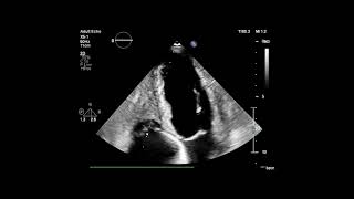 Video 1 thrombus RV [upl. by Llerrod258]