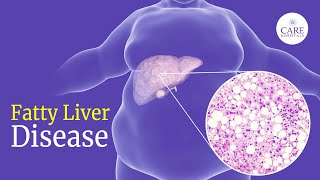 How Dangerous can be Fatty Liver  Fatty Liver Symptoms Causes and Treatment amp Prevention [upl. by Gautious766]