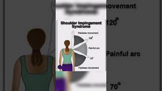 Shoulder impingement syndrome painful arc syndrome shoulderpain physiotherapyyoutubeshorts viral [upl. by Steele826]