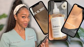 Glycolic Acid as a deodorant and hyperpigmentation hack [upl. by Aztinaj]