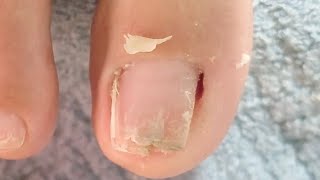 Clean up toes with nail fungus  part 85 NhaNguyenPhanThiet [upl. by Rafaelof229]