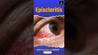 What is Episcleritis  Ophthalmology  eye ophthalmology episcleritis eye peramedical [upl. by Aljan]