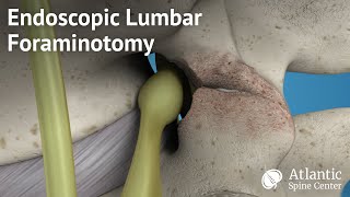 Endoscopic Lumbar Foraminotomy [upl. by Gerianna]