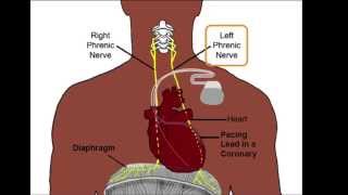 Left Phrenic Nerve Anatomy Relative to the Coronary Venous System [upl. by Llerdnod]