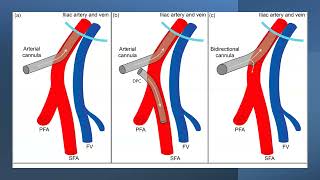 06 Cannulation by Dr Dipanjan Chatterjee ECMO INDIA OCT 2024  Day 01 [upl. by Martita481]