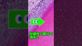 何かに似ている病理組織像 ⑱ dermatopathology 皮膚科専門医 [upl. by Ilil]