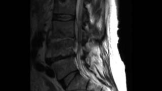 Discitis Osteomyelitis [upl. by Jeconiah]