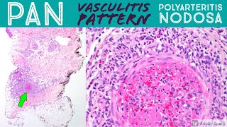 Polyarteritis nodosa amp leukocytoclastic vasculitis pattern Inflammatory Dermpath Basics [upl. by Einwahr]