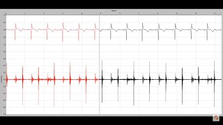 Holosystolic murmur in a child with a membranous ventricular septal defect [upl. by Neitsabes]