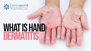 What is Hand dermatitis Shots [upl. by Rehpotsrhc]