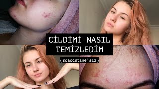 SİVİLCELERİMDEN NASIL KURTULDUM ✨ roaccutane’sız [upl. by Secilu108]