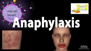 Anaphylaxis Animation [upl. by Albion]