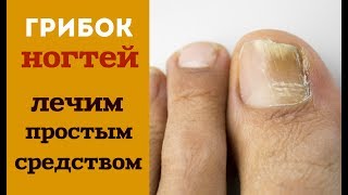 КАК ЛЕЧИТЬ ГРИБОК НОГТЕЙ ПРОСТОЙ И ЭФФЕКТИВНЫЙ МЕТОД ЛЕЧЕНИЯ [upl. by Navaj]