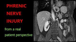 PHRENIC NERVE INJURY PARALYZED DIAPHRAGM SYMPTOMS TREATMENTS MedEd MedTwitter [upl. by Stoddart]