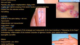 99P Psoriatic Arthritis quotpencil in cupquot deformity [upl. by Ylrevaw378]