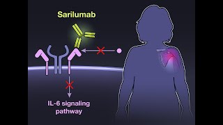 Sarilumab for Relapse of Polymyalgia Rheumatica  NEJM [upl. by Donna]