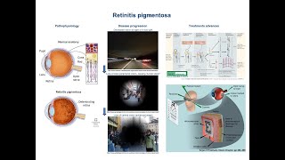 Retinitis pigmentosa pathophysiology and treatment advances [upl. by Nageet856]