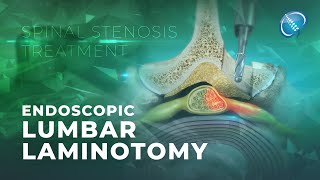 What is Endoscopic Lumbar Laminotomy  Laminectomy [upl. by Adamsen]