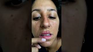 Cystic acne and blackheads removal  Newest pimple pops for 2022 [upl. by Neel]