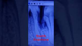 Tooth fracture treatment shortvideotoothdental fracturedtoothtoothfracturetreatment [upl. by Catto239]