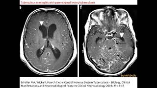 31 Neurosarcoidosis and tuberculous meningitis leptomeningeal perivascular granulomatous [upl. by Renfred]